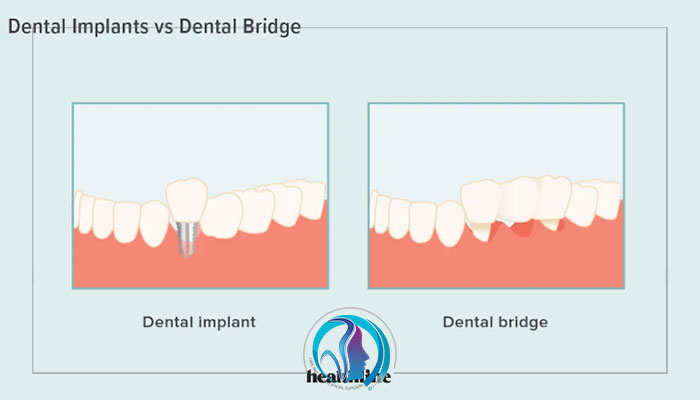Bridges and implants differences